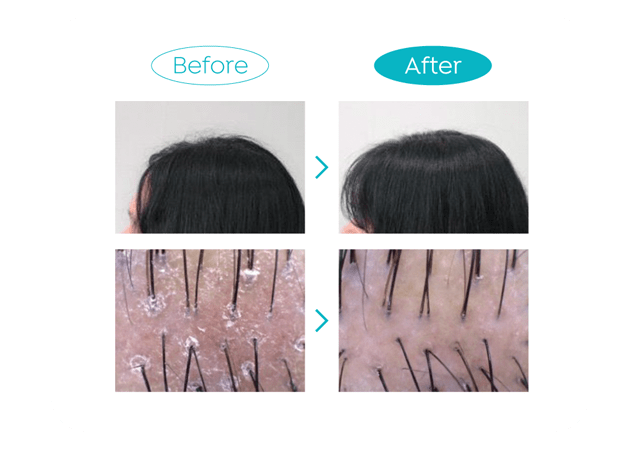 アピュー ミント スカルプヘアビネガートリートメント